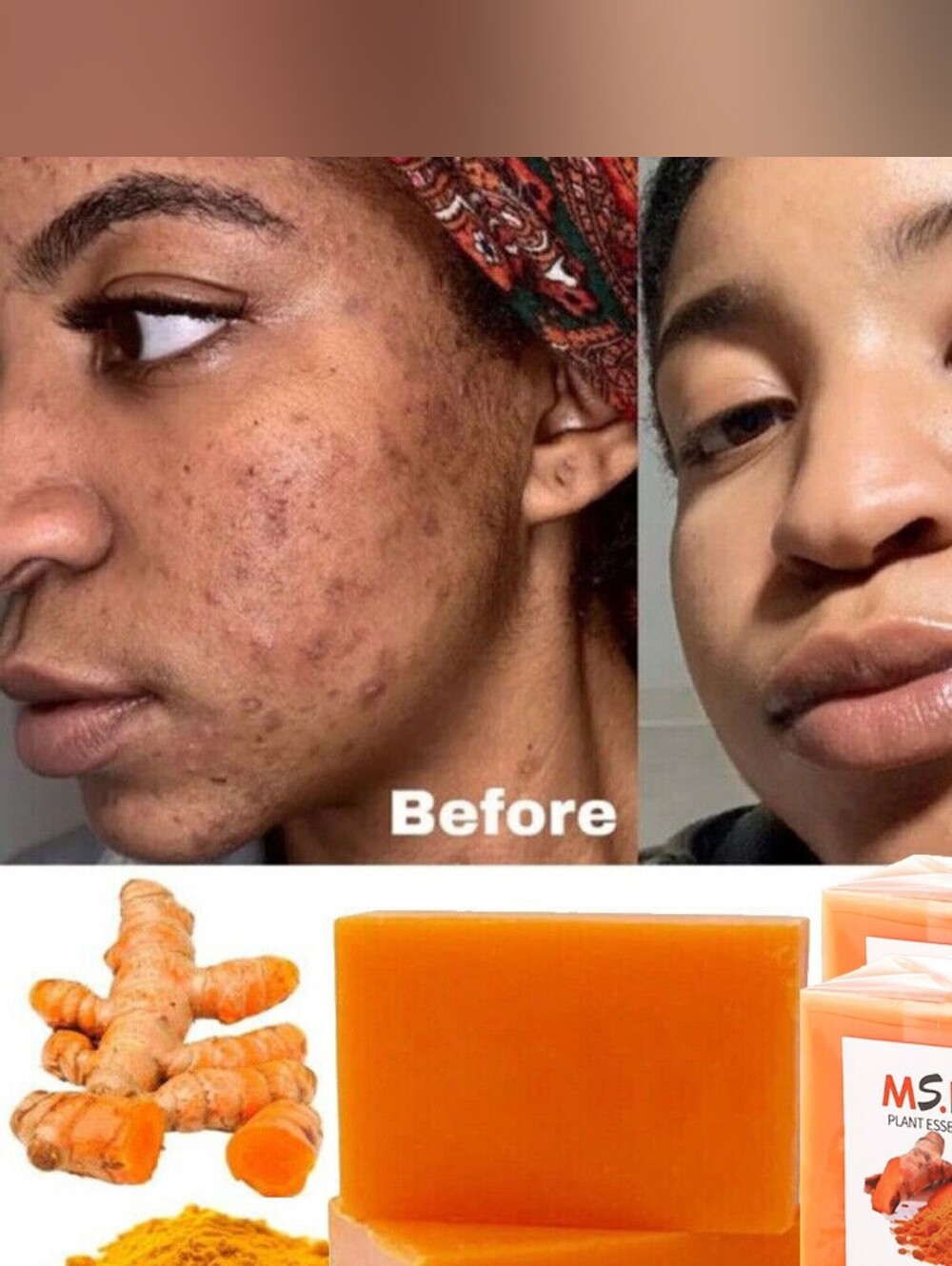 Tumeric Soap For Dark Spots, Skin Lightening, Anti Acne Skin Cleansing Soap Bar